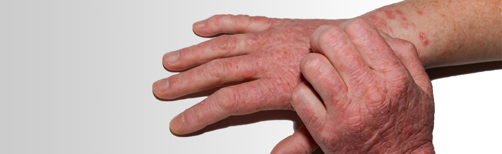 Mitigating The Risk Of Glove Allergies In Healthcare